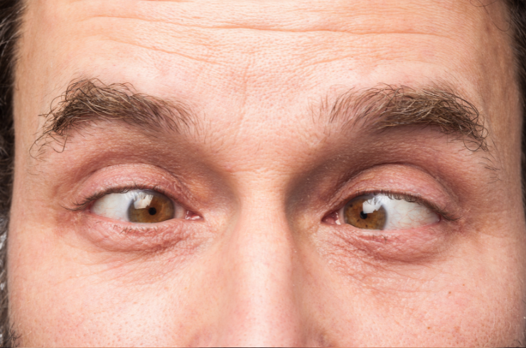 squint